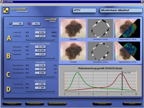 Beispiel einer Muttermal-Analyse mit microDERM® (© Visiomed AG)